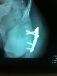 The plate in Janely's hip
